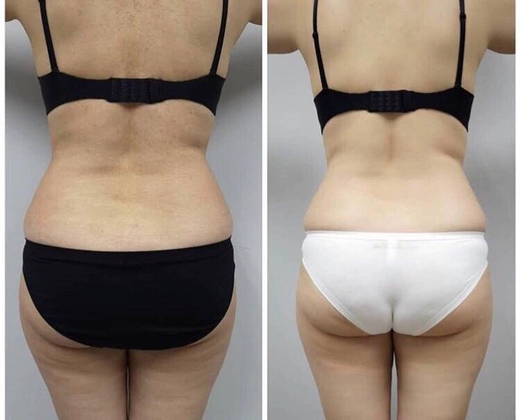 ИЗБАВЬСЯ ОТ ЦЕЛЛЮЛИТА И ЖИРОВЫХ ОТЛОЖЕНИЙ БЕЗОПАСНО И ЭФФЕКТИВНО! - Изображение #4, Объявление #1665699