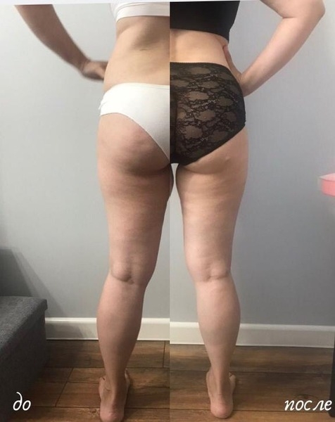 ИЗБАВЬСЯ ОТ ЦЕЛЛЮЛИТА И ЖИРОВЫХ ОТЛОЖЕНИЙ БЕЗОПАСНО И ЭФФЕКТИВНО!!! - Изображение #3, Объявление #1665703