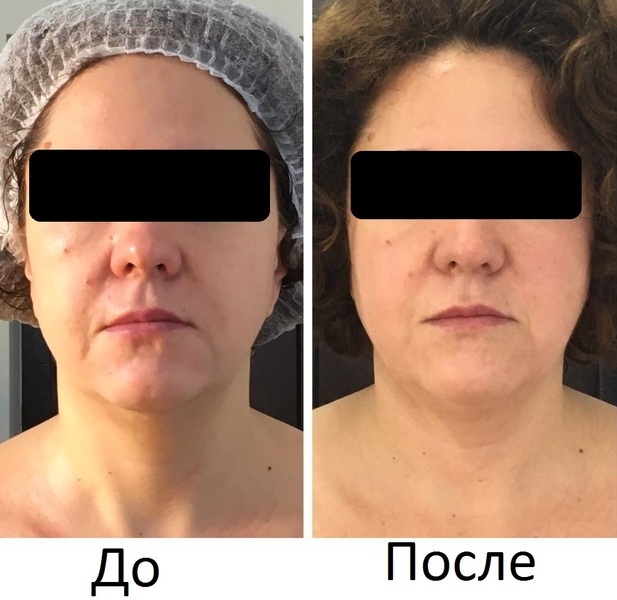  Новый 3D Smas Лифтинг, новейшая технология, впервые в Казахстане - Изображение #3, Объявление #1668332