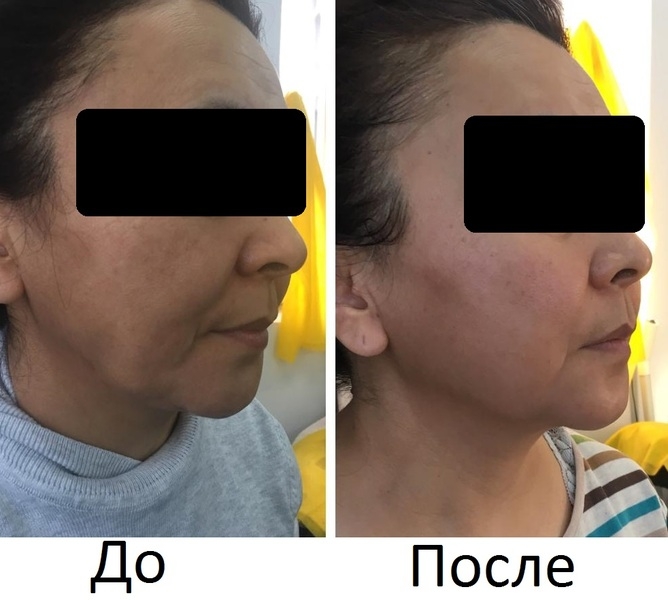  Новый 3D Smas Лифтинг, новейшая технология, впервые в Казахстане - Изображение #4, Объявление #1668332