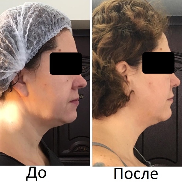  Новый 3D Smas Лифтинг, новейшая технология, впервые в Казахстане - Изображение #5, Объявление #1668332