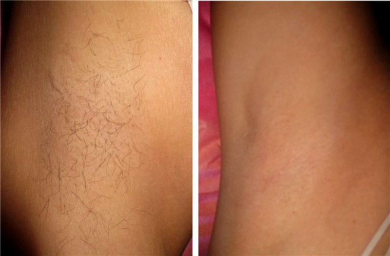 Шугаринг. Сахарная эпиляция. Персидская эпиляция - Изображение #3, Объявление #1684301